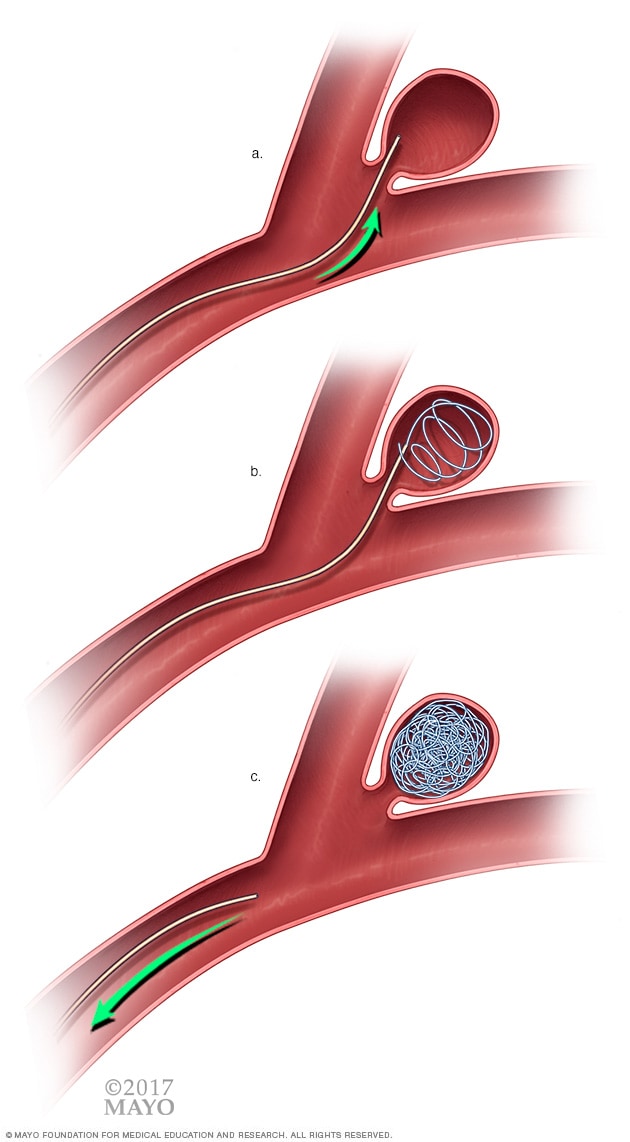 وضع الشائع داخل الأوعية الدموية