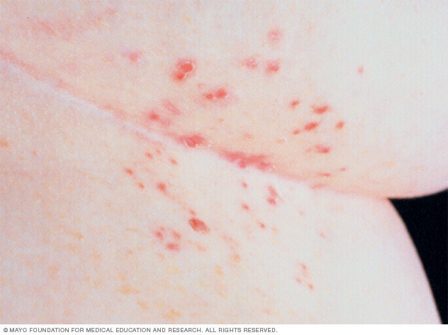 疥疮会导致皮肤上出现隆起的小水疱
