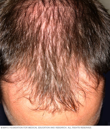 男性的头发往往从额头开始脱落。