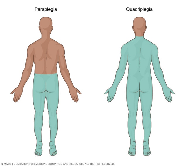 La parte del cuerpo afectada por la paraplejia y la cuadriplejia