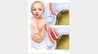 How infant reflux occurs